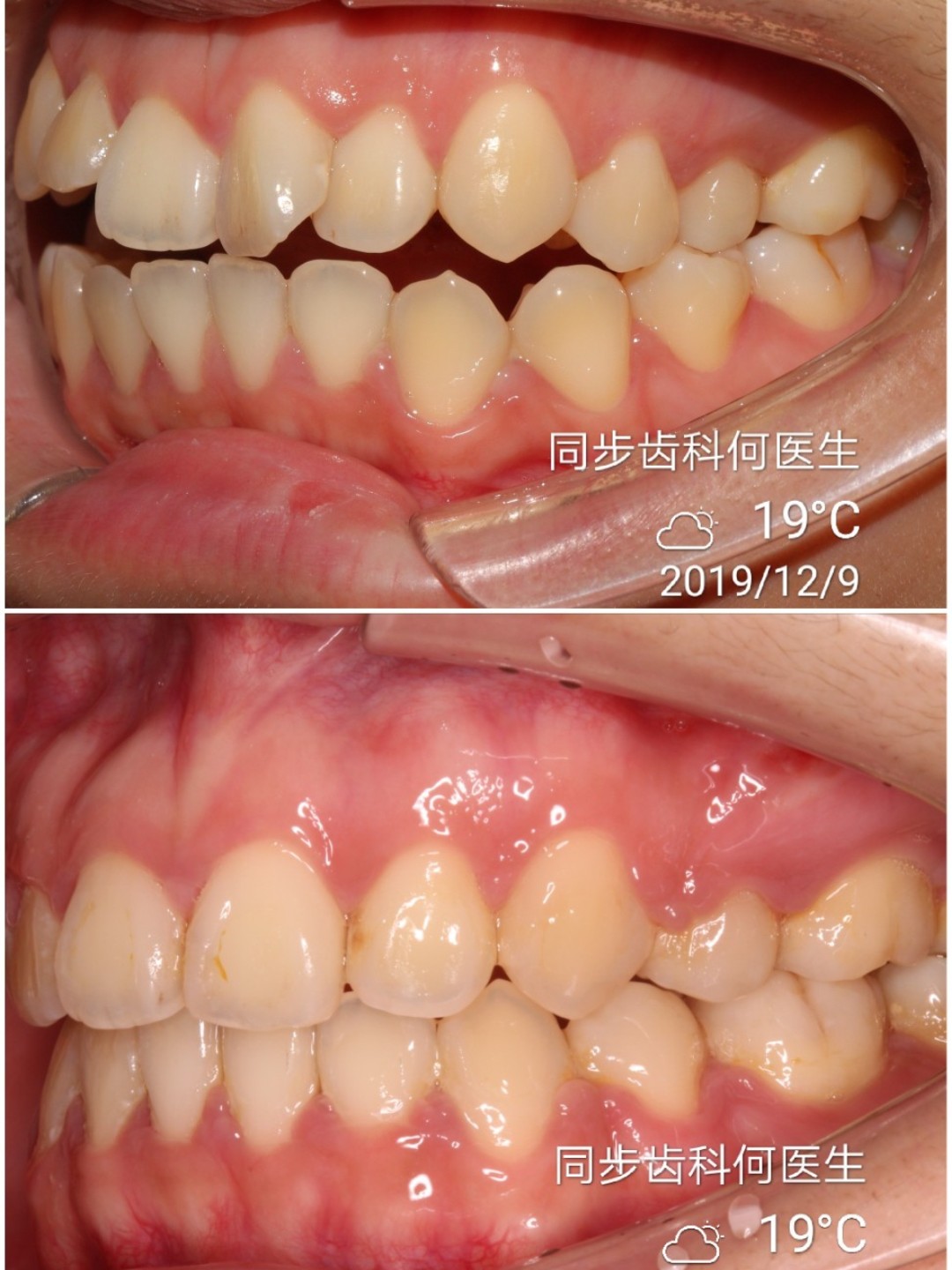 今日份正畸病例分享—前牙开合正畸趣事:我记得在矫正_圈子-新氧美容