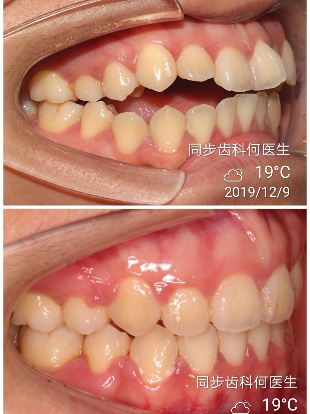 今日份正畸病例分享—前牙开合正畸趣事:我记得在矫正_圈子-新氧美容