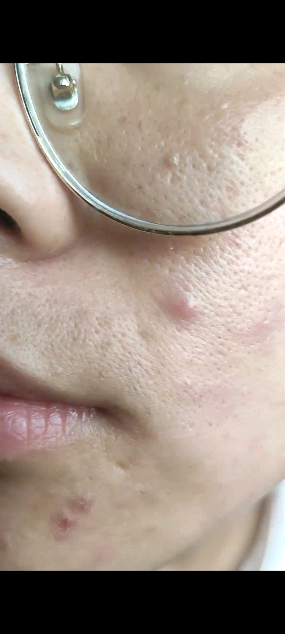 请问我这个皮肤问题主要是毛孔粗大还是痘坑呢,如果要激光美容的话