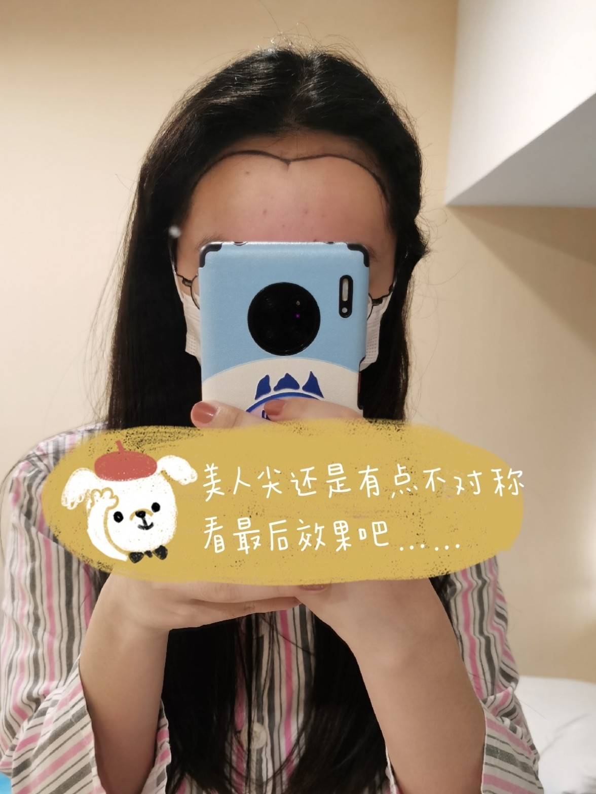 植发完成 秃头少女6 植完发的新鲜反馈来了 洋 圈子 新氧美容整形