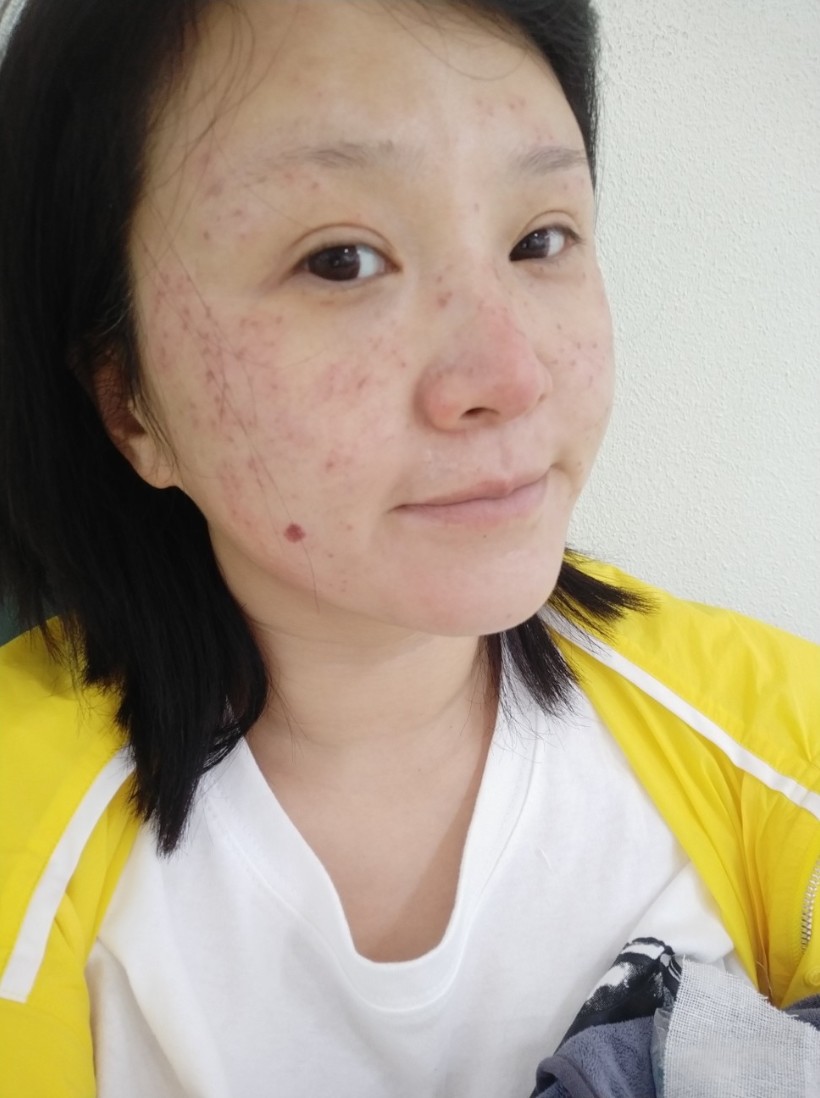 超皮秒全面部祛斑嫩肤激光祛斑第三天,第一二张是第_圈子-新氧美容