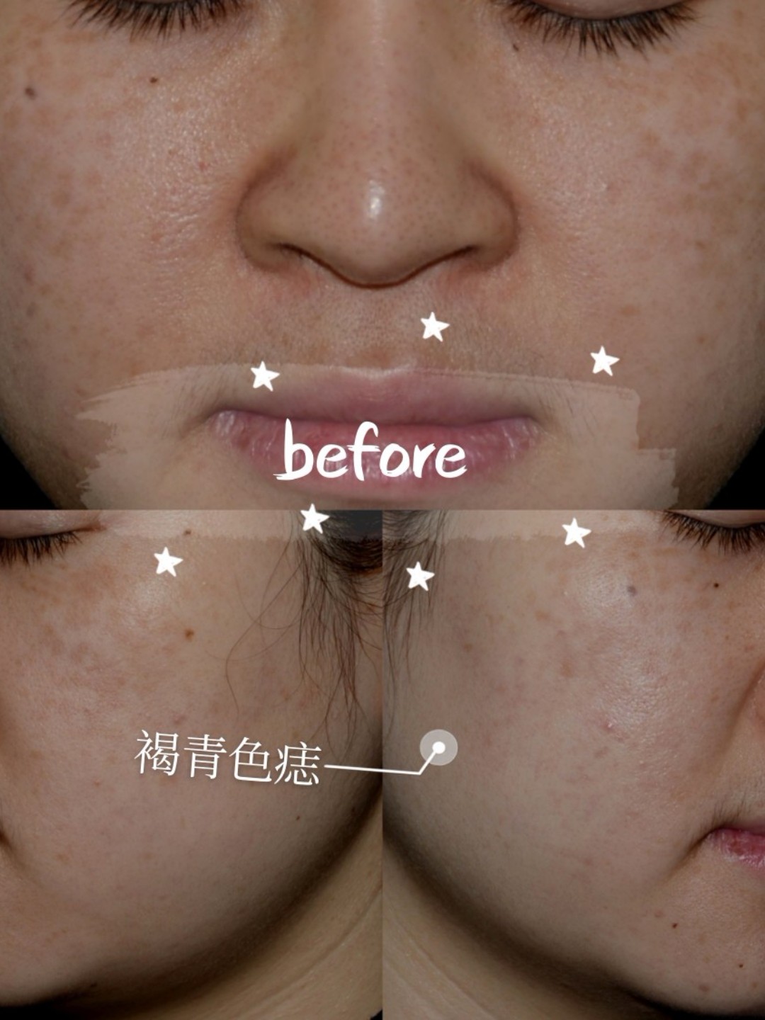 97今日案例分析:99治疗前顾客两侧面颊长满褐青色痣,_圈子-新氧