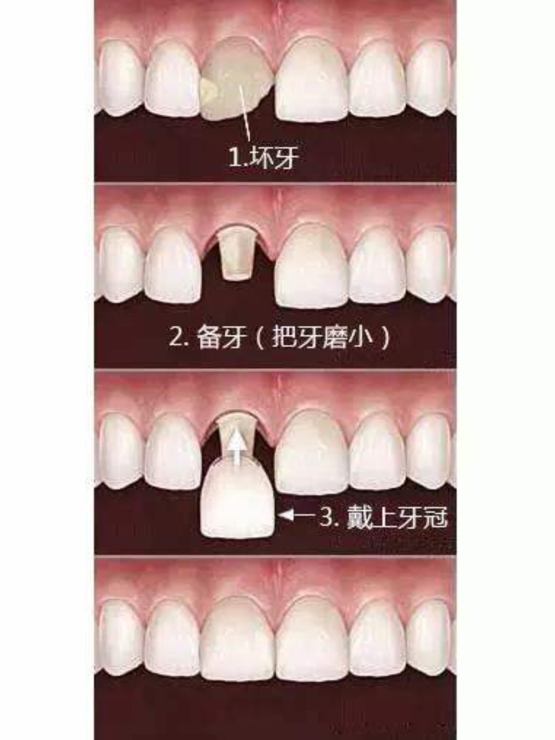 你还在用传统的美容冠(烤瓷牙)技术么?牙贴面了解一下?