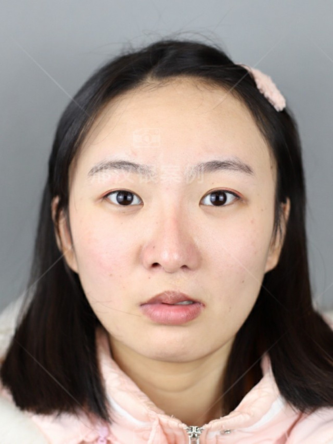 【全肋颗粒软骨唇裂鼻修复-术后3个月】