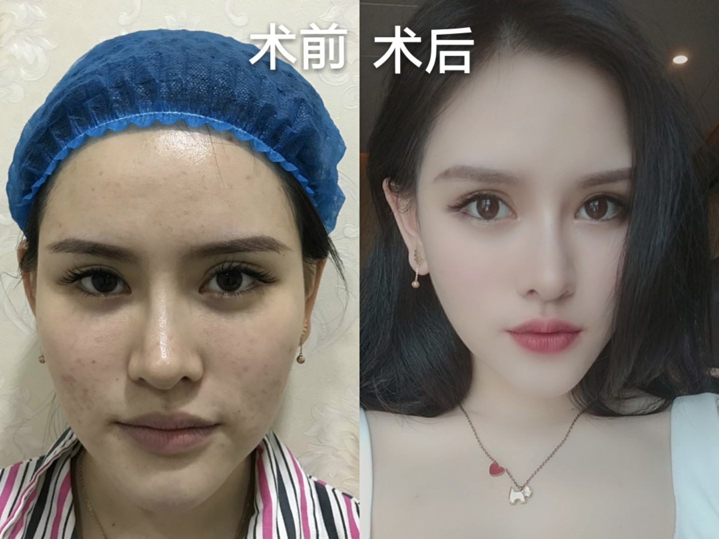 而面部至高点应该是眉弓,所以导致面部不够立体,眉骨可以在高一些的
