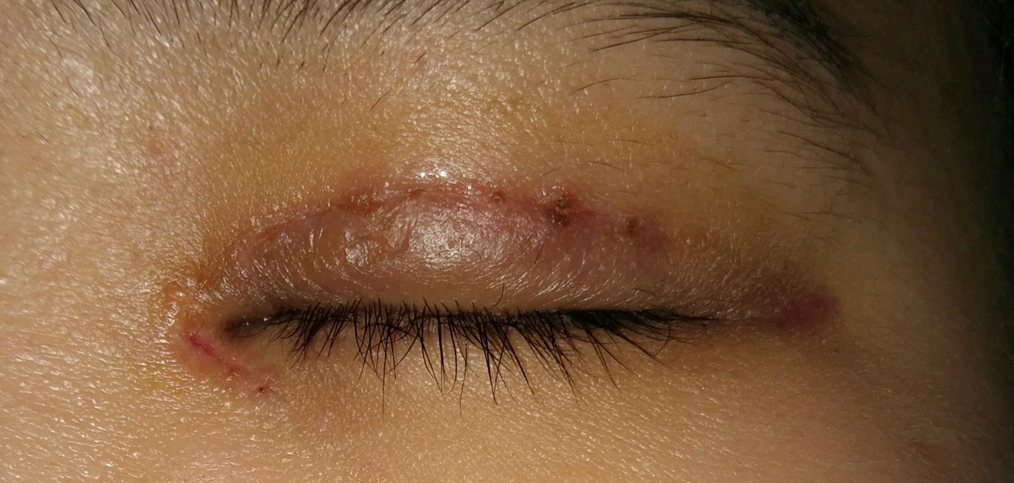 拆线后结痂未掉干净可以洗脸了吗