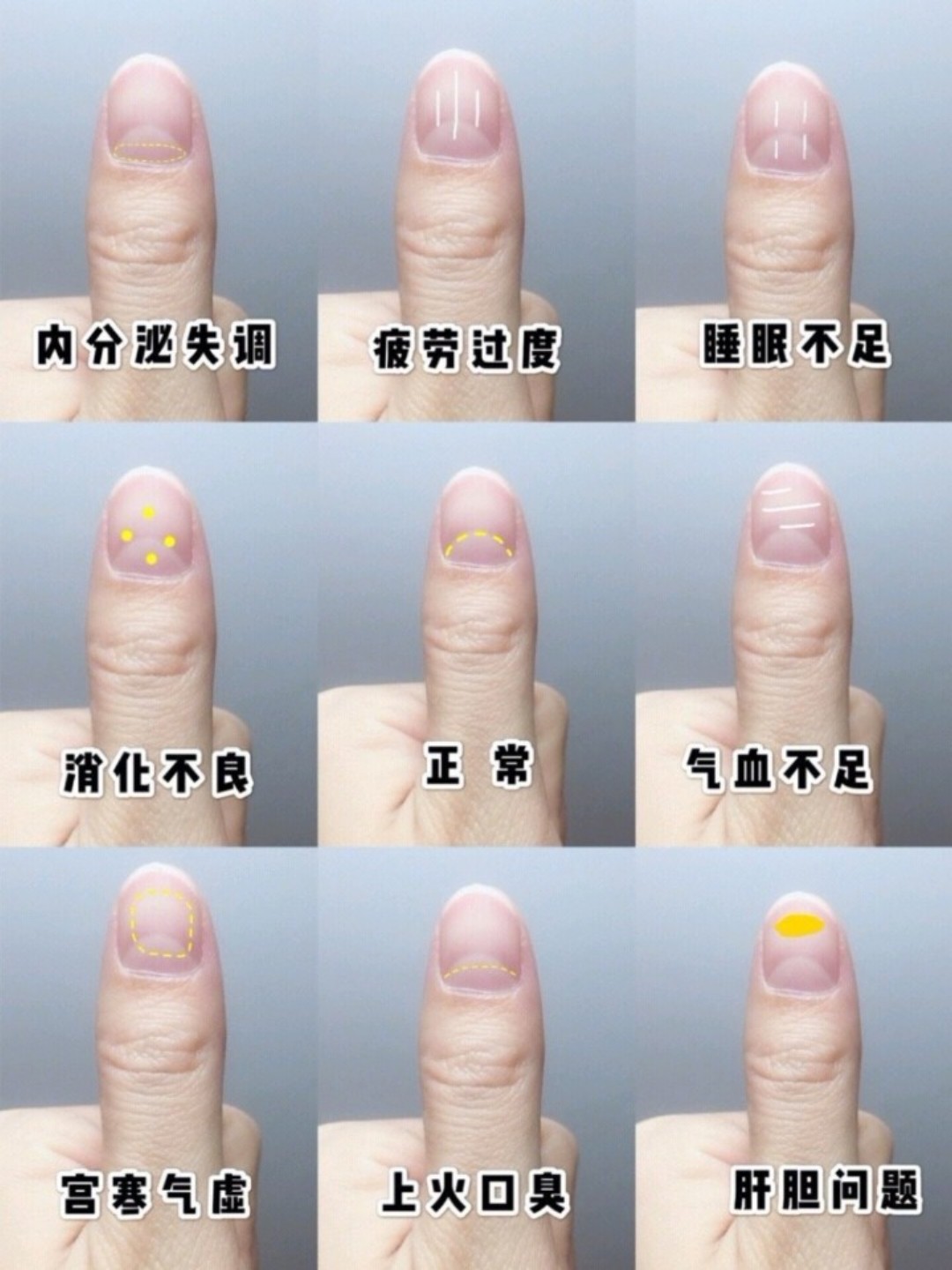 为什么指甲上会出现"竖纹"?或许是这4个原因,不妨_圈子-新氧美容整形