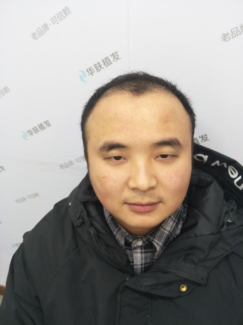 植发三个月跟九个月的照片