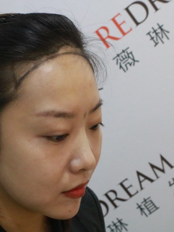 少女必备圆形发际线!