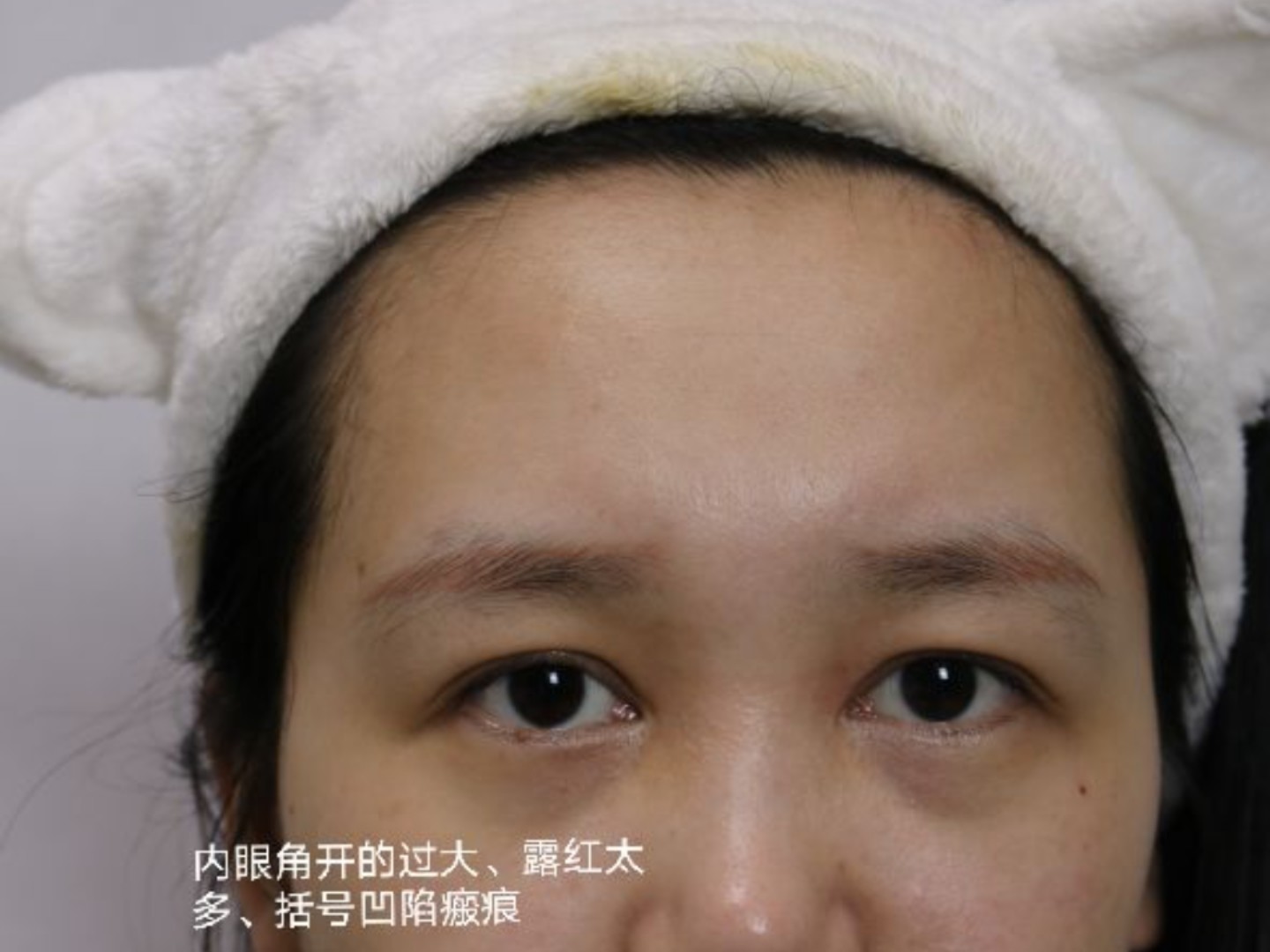 开内眼角如果开的过多,会导致眼角太大,露红太多,开_圈子-新氧美容