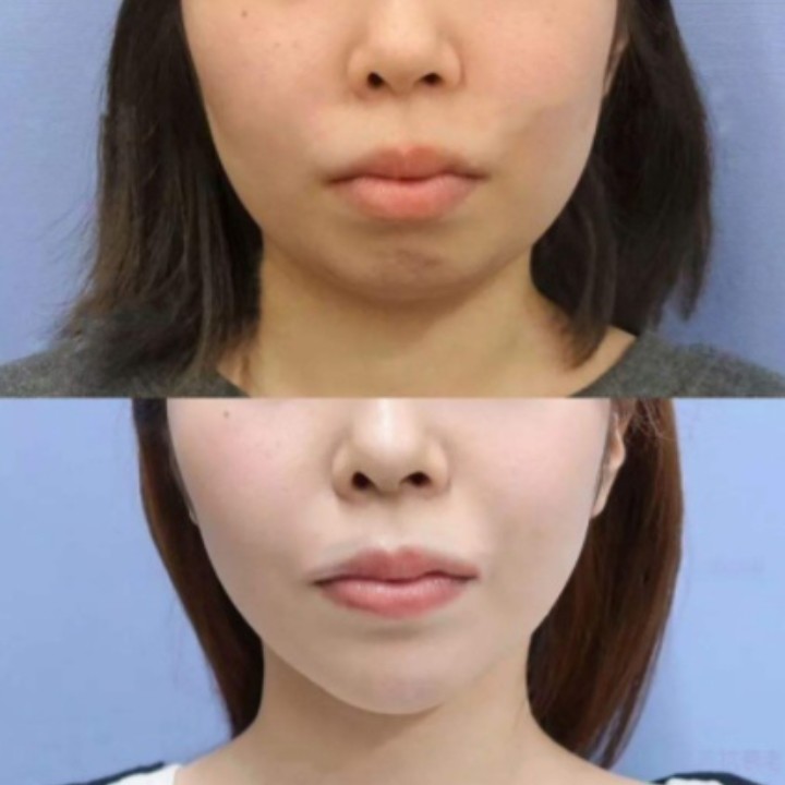 瘦脸针又称为肉毒素,可以使得肌肉萎缩,减小体积,从_圈子-新氧美容