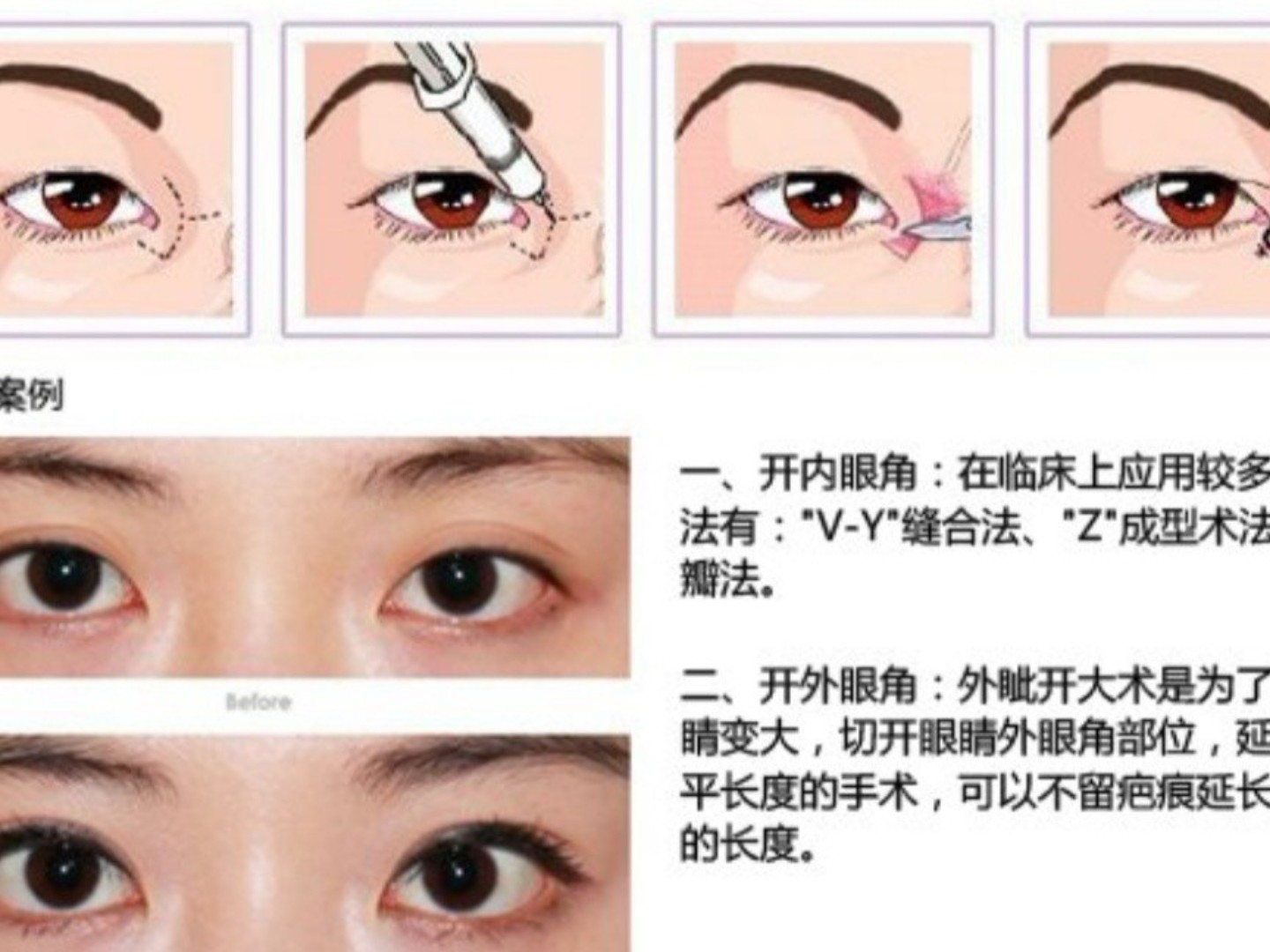 改变眼型的神奇开眼角术