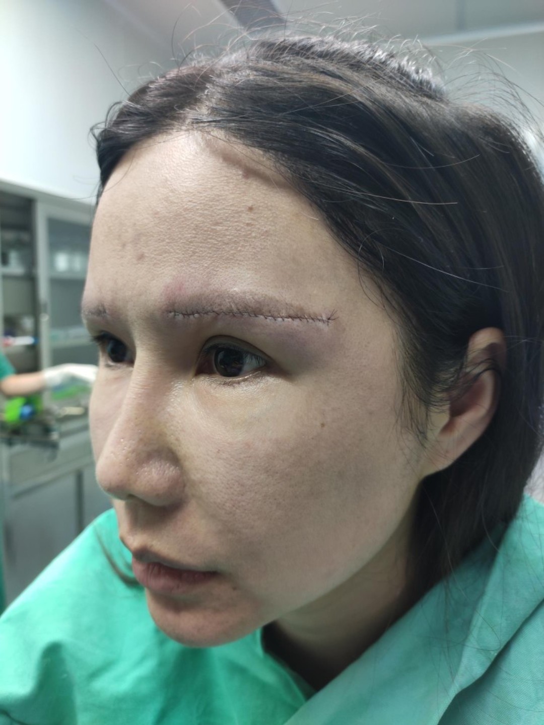 皮肤也松了,连眉毛下的眼皮都开始下垂,做了一次之后,眼睛明显提升了