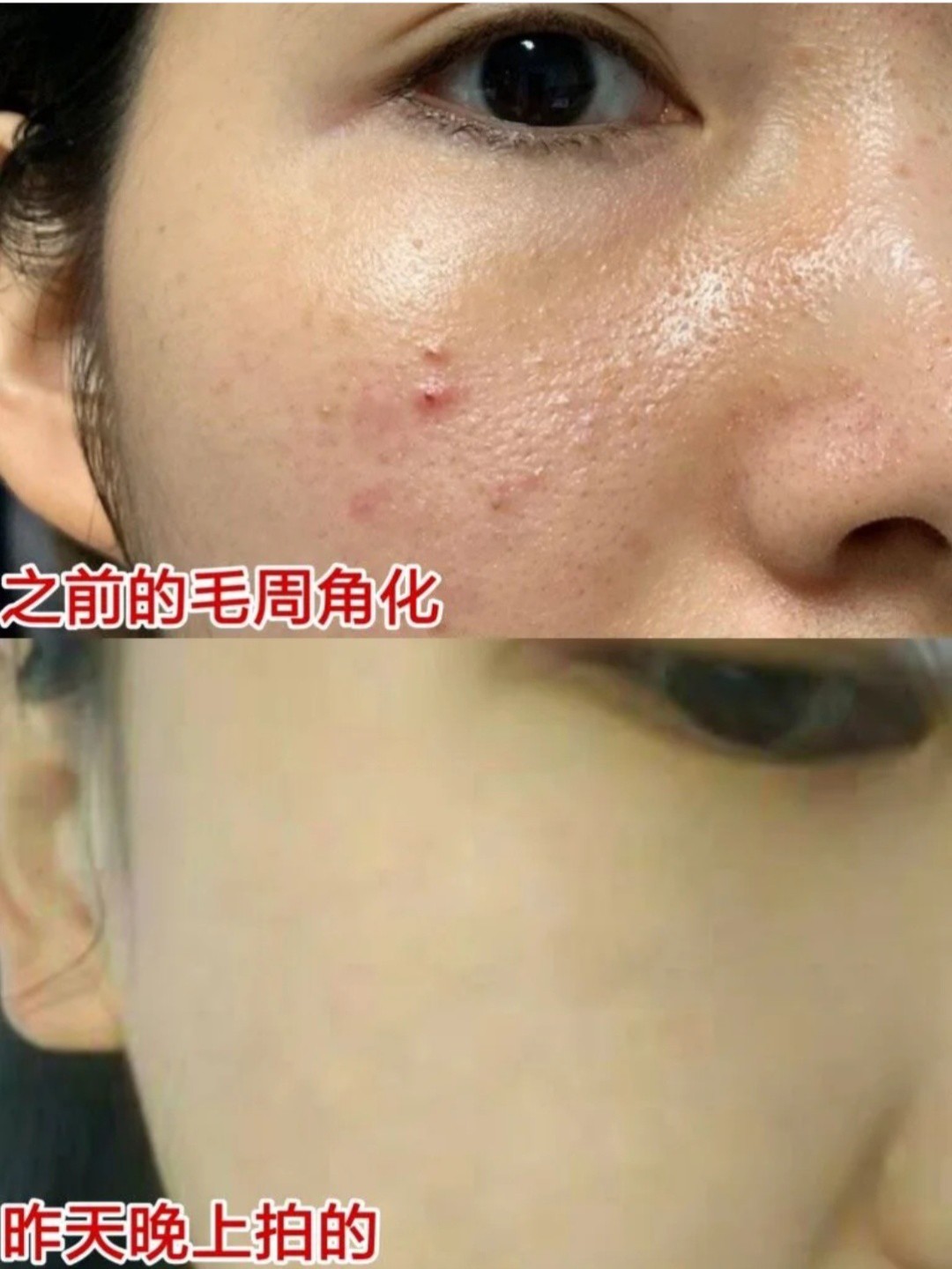 眼睛和鼻子两侧鸡皮肤(眼睛鼻子周围有类似鸡皮肤)