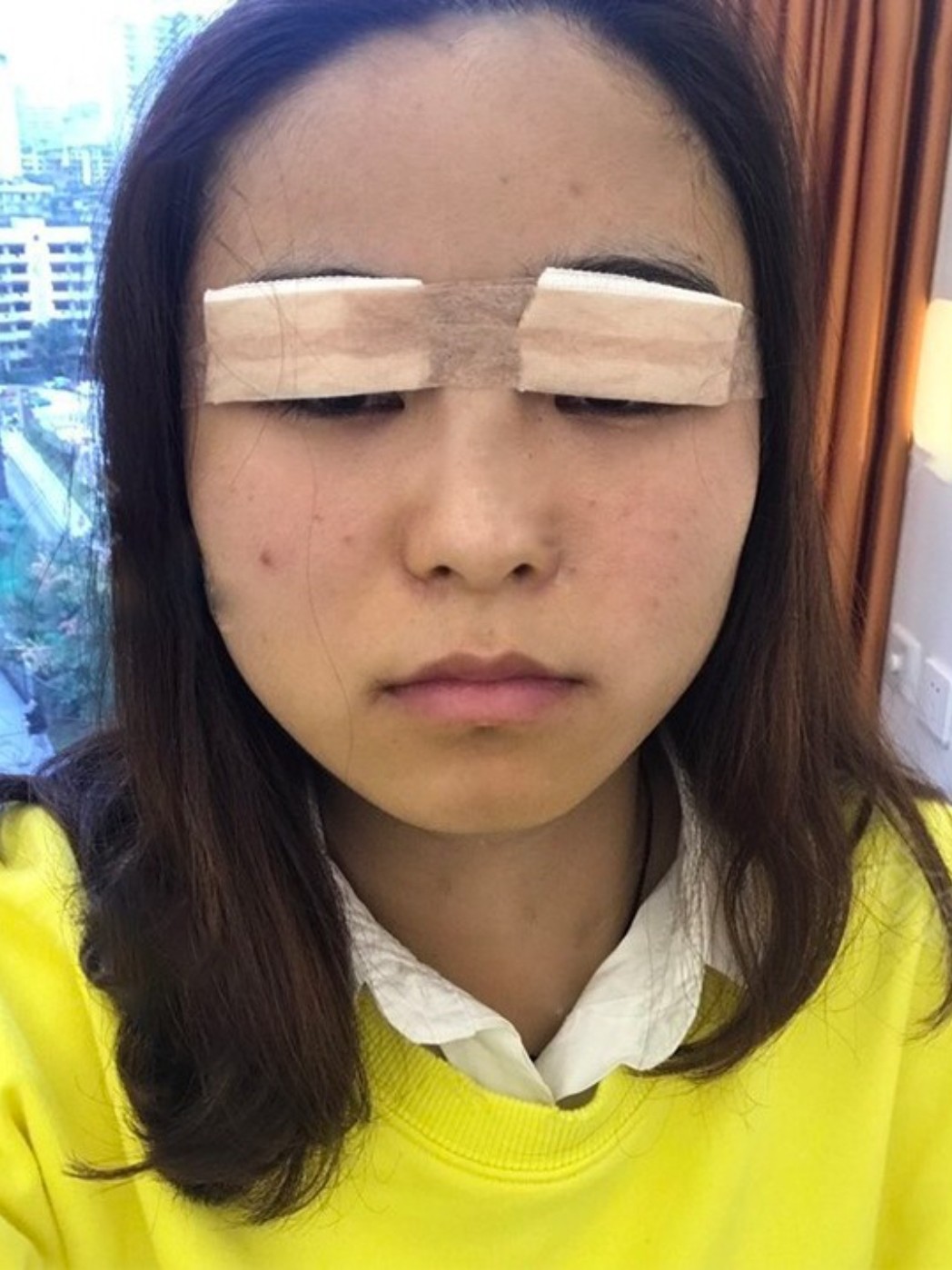 术后第一天,被纱布包扎上了,看不见具体的双眼皮的样_圈子-新氧美容