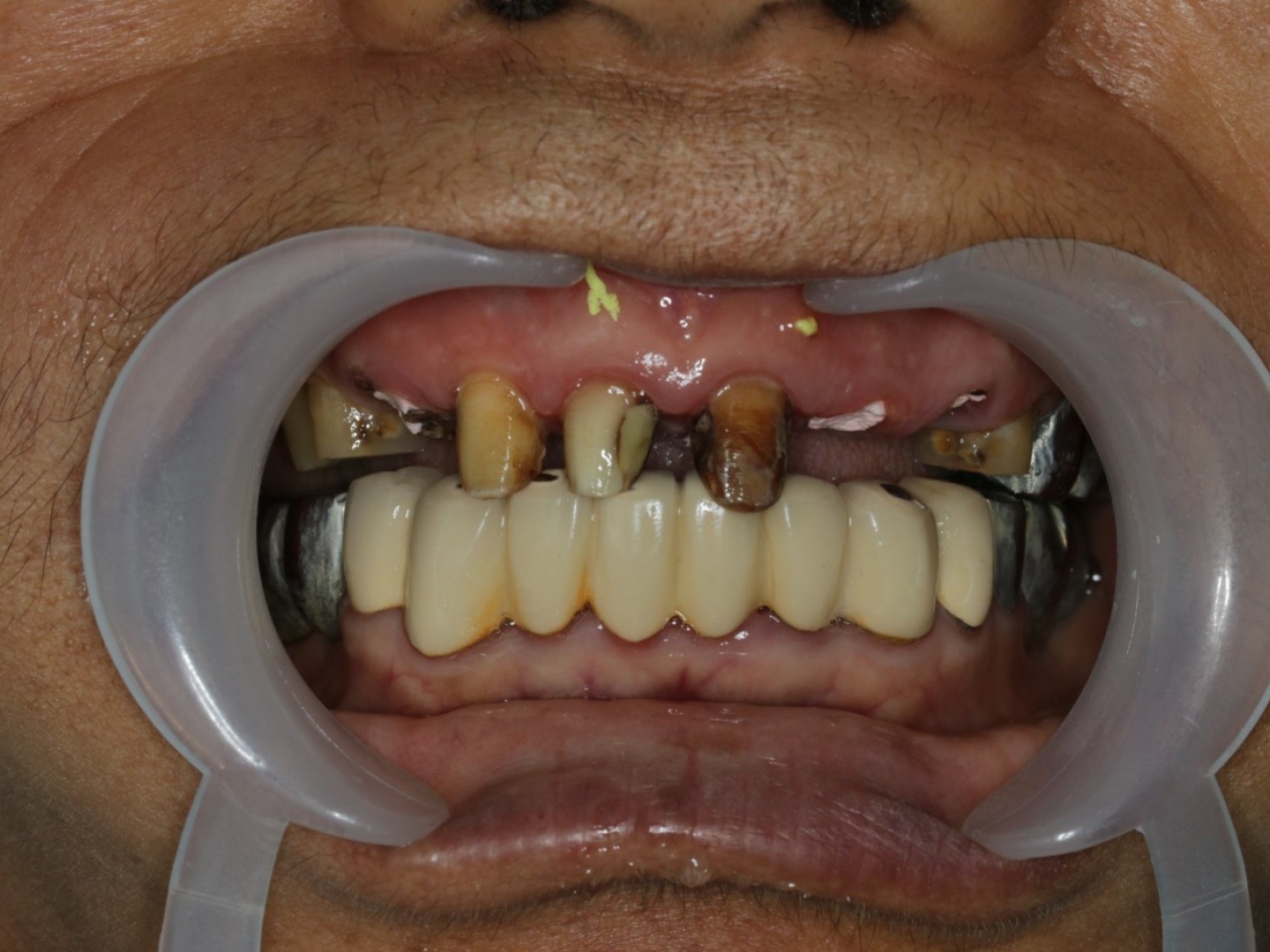 前几天带我姥爷过来面诊,早起他做了烤瓷牙,现在都坏_圈子-新氧美容