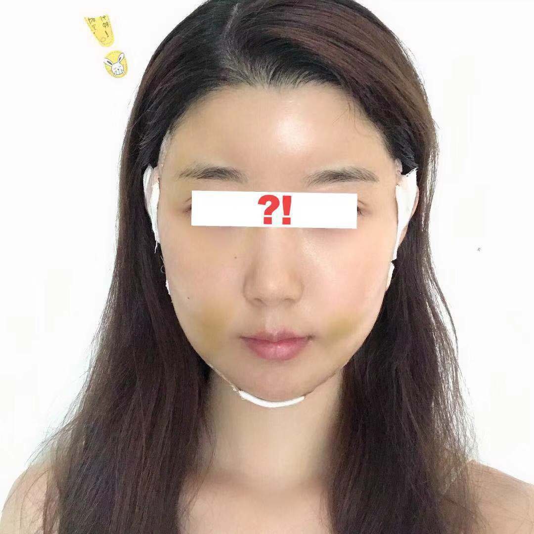 光纤溶脂瘦脸 术后5天