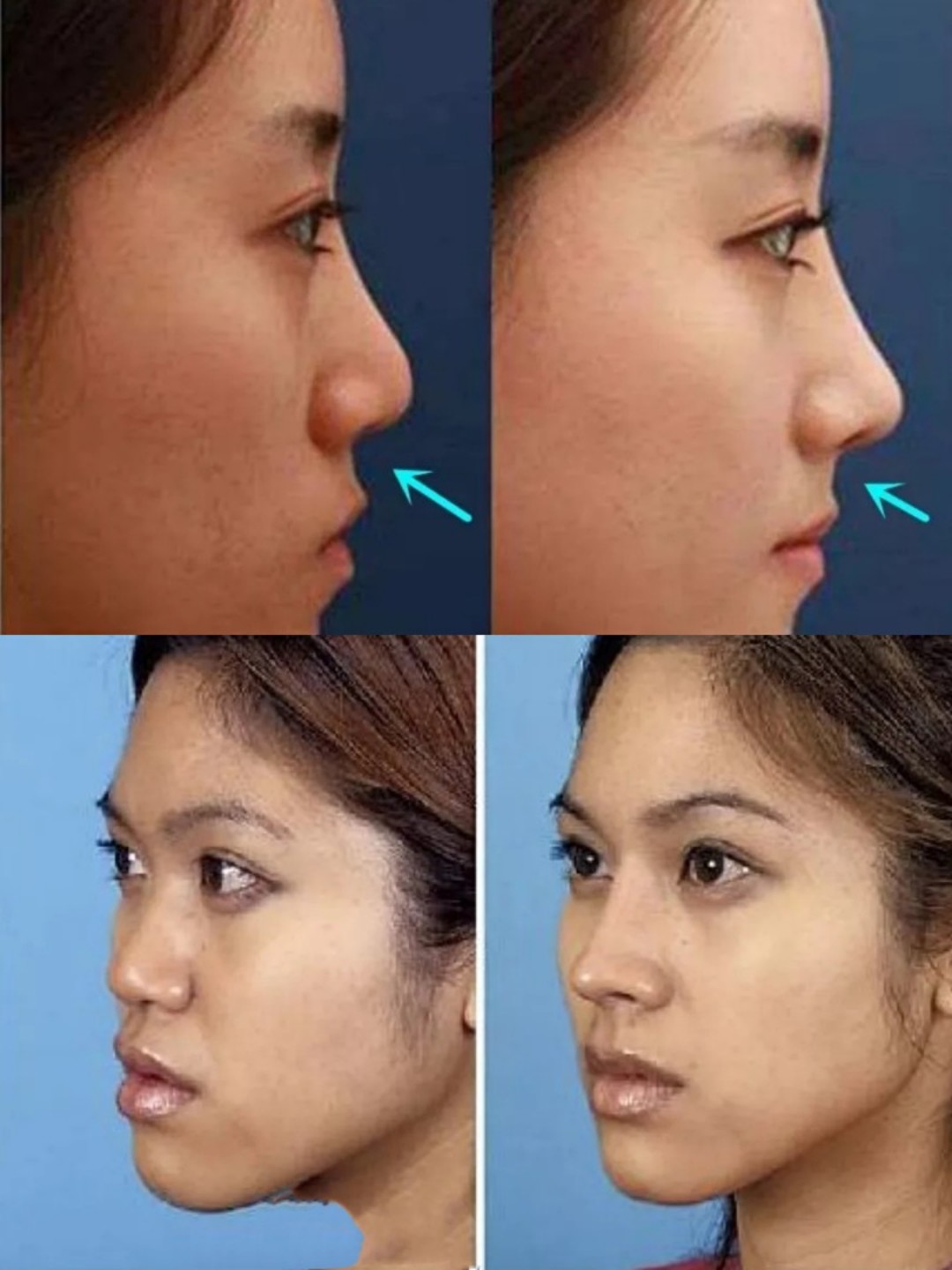 想要高鼻子不可忽视这里——鼻基底