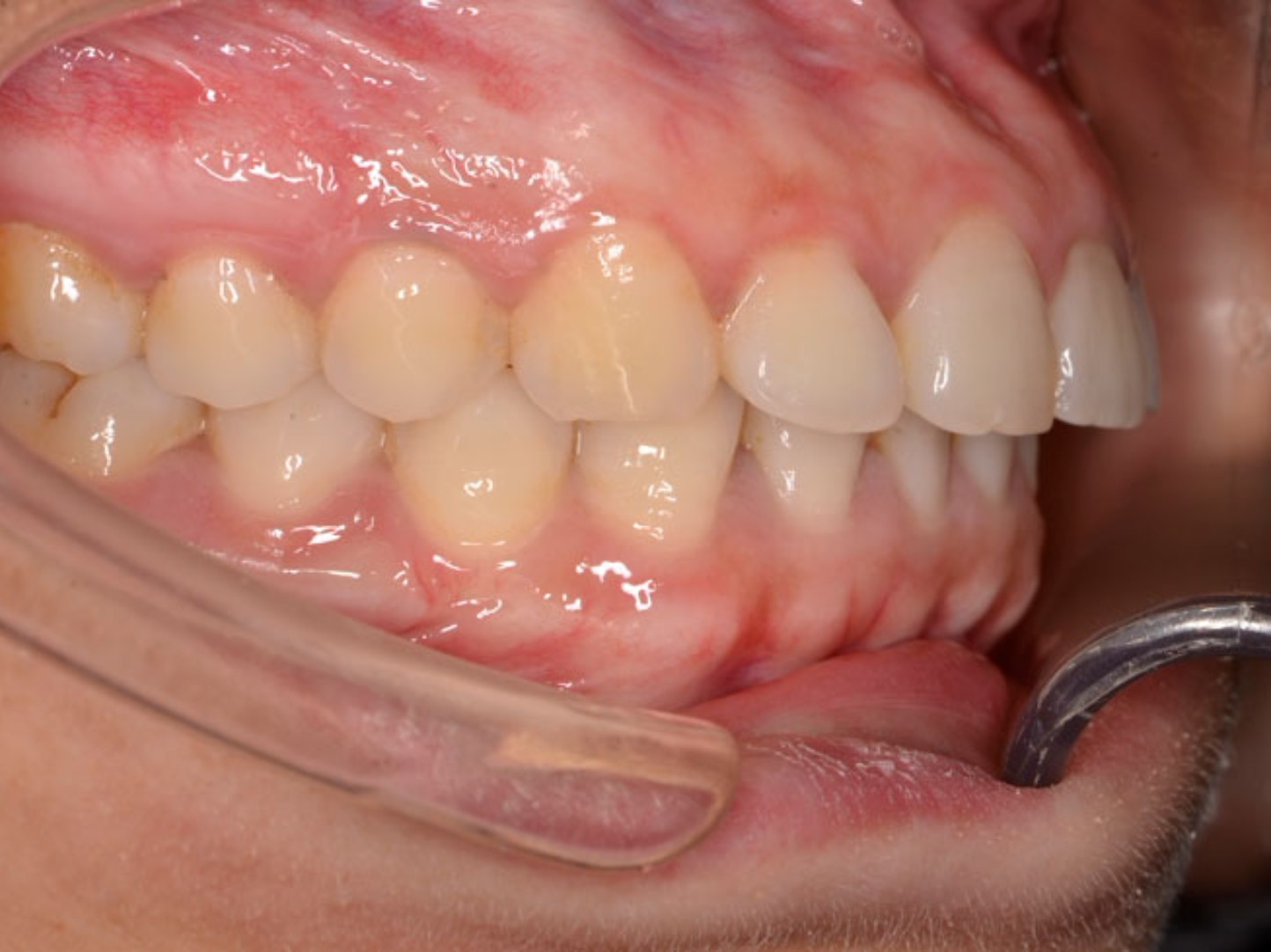 牙齿我们一日三餐都是必须要用的(咀嚼功能)