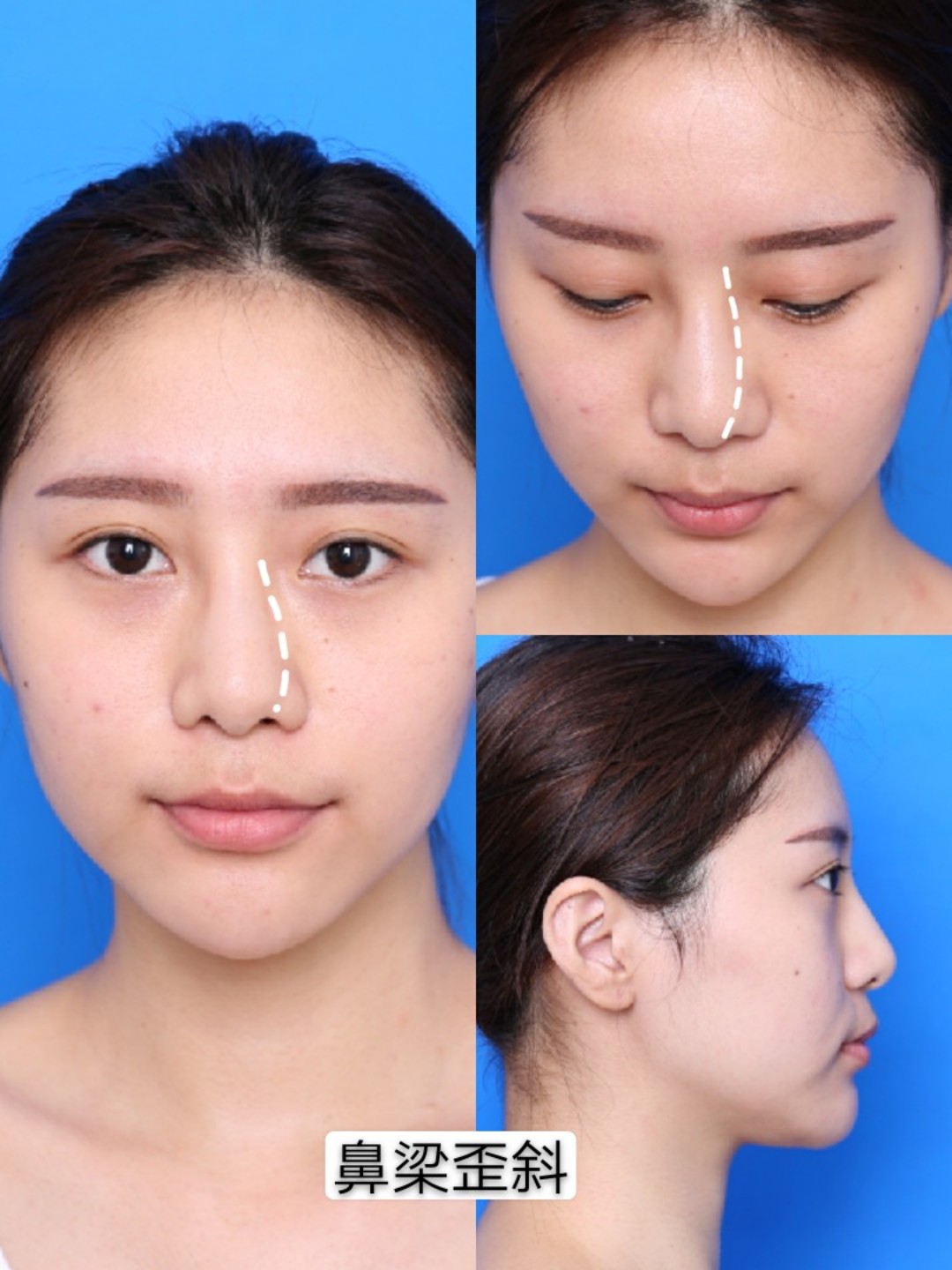 我鼻子变歪了怎么办