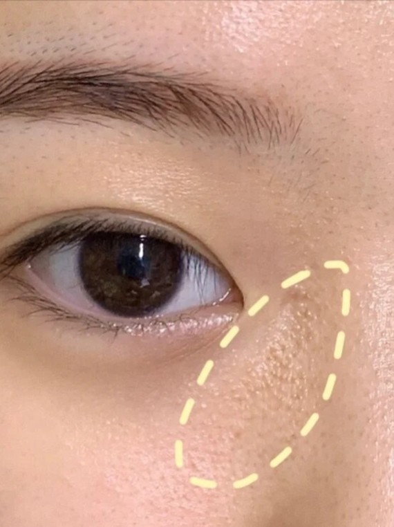 闭口来着,勤勤恳恳大半个月也就额头下巴稍微好了一点,鼻子到眼睛下边