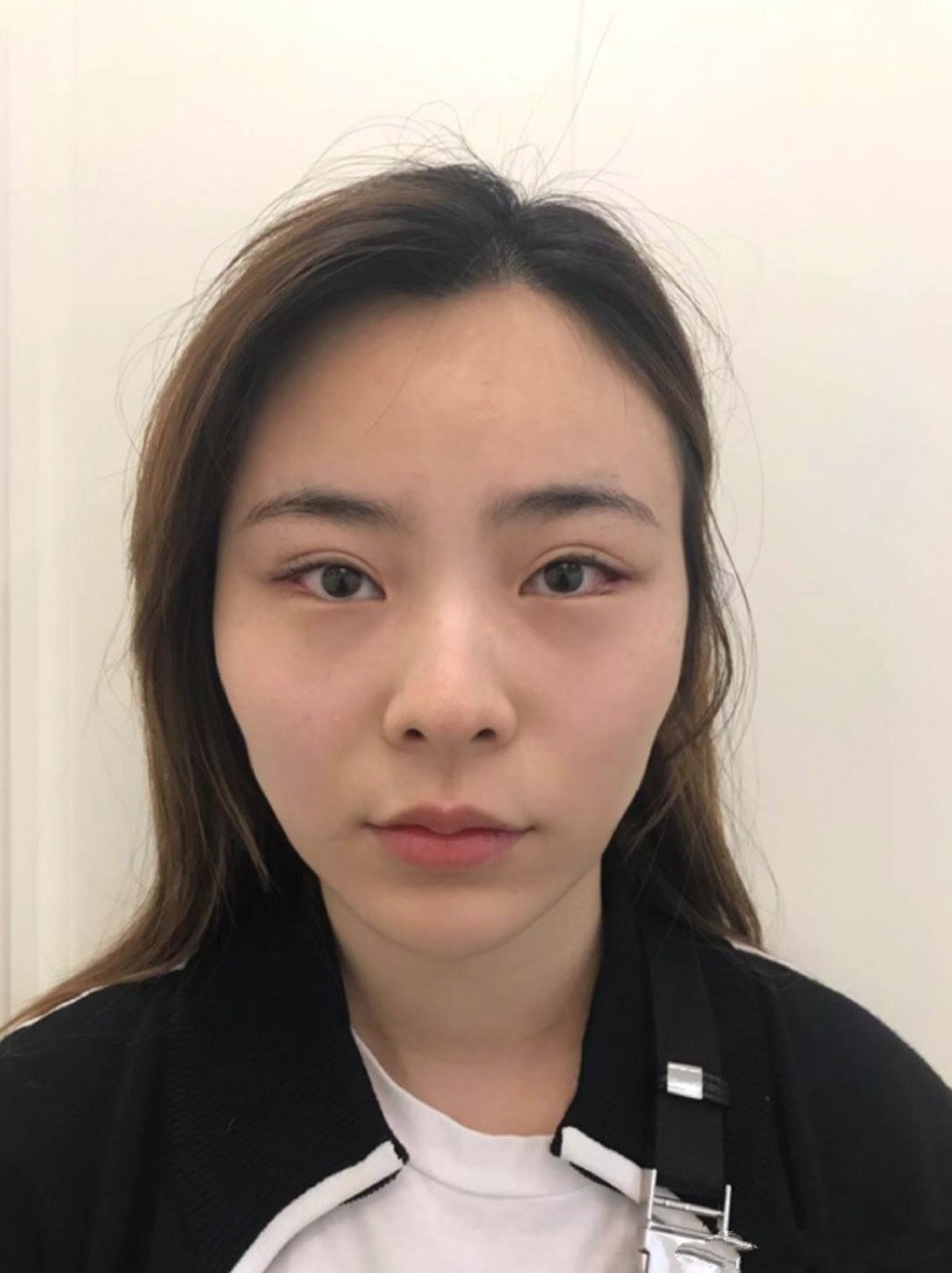 常见的脸部脂肪填充的适用部位1, 面部脂肪少,过于_圈子-新氧美容整形