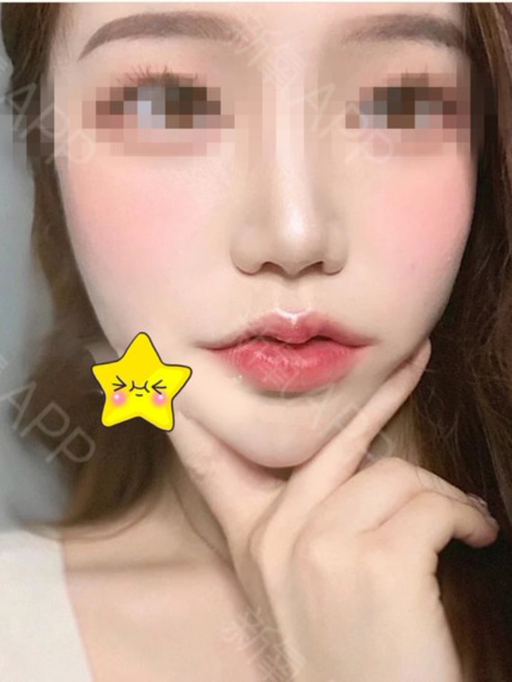 更是一种力量,嘴角上扬后的我好像打_圈子-新氧美容整形