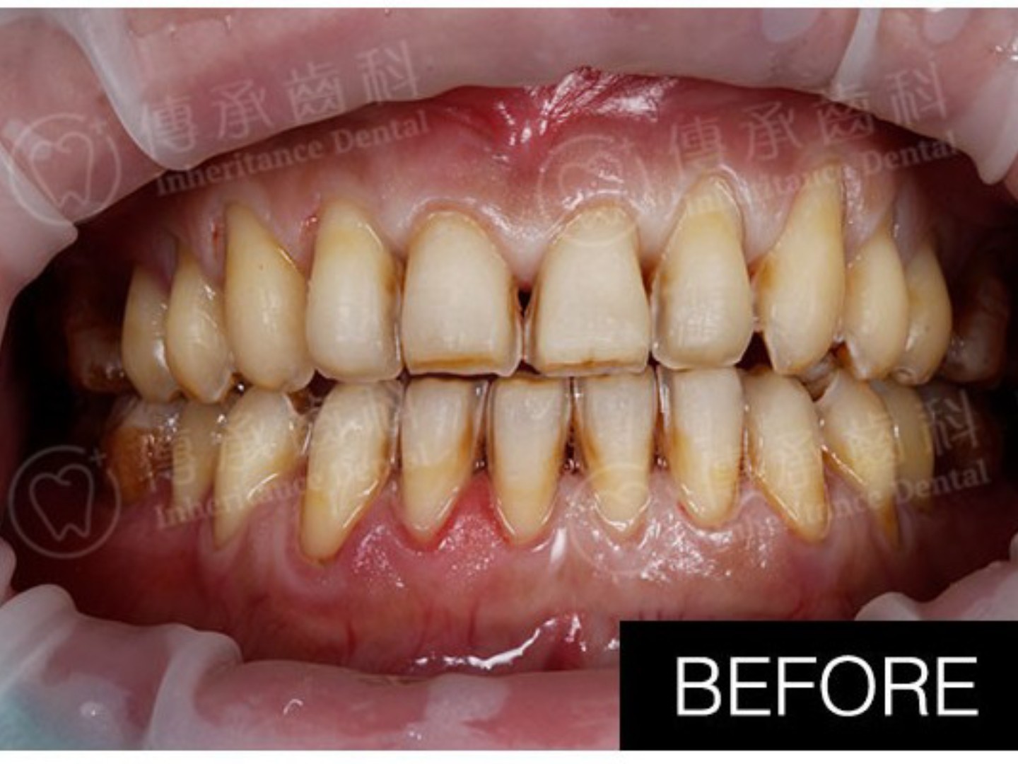 重度色素牙,非常自卑,我的工作也是对外表要求比较严_圈子-新氧美容