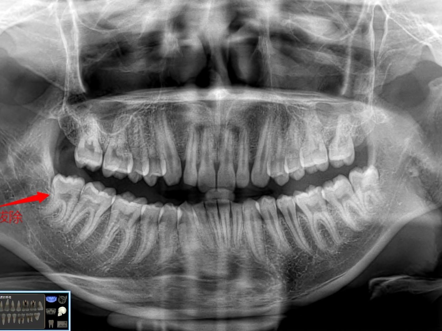 前台服务很好,填资料拍片,面诊医生,检查一下口腔情况,原来我的智齿拔