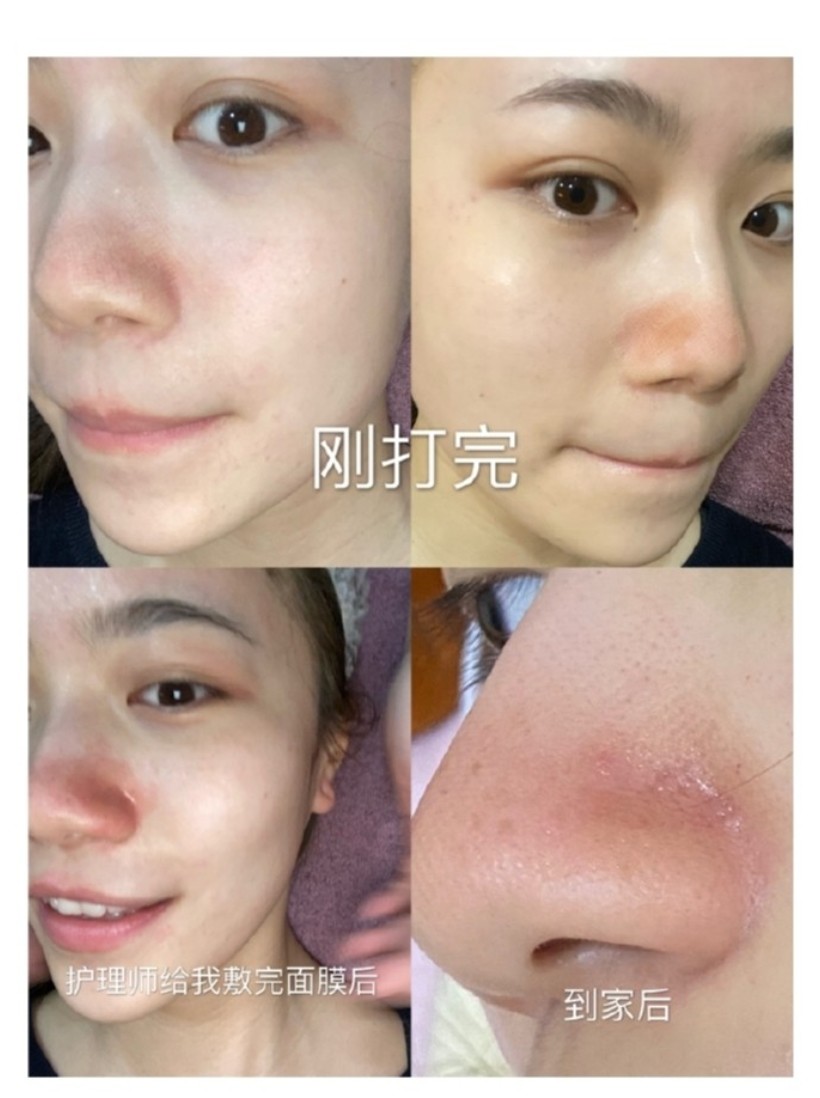 这是来自一个漂亮姐姐的镭射净肤分享!超级有用,大家耐心看完哦