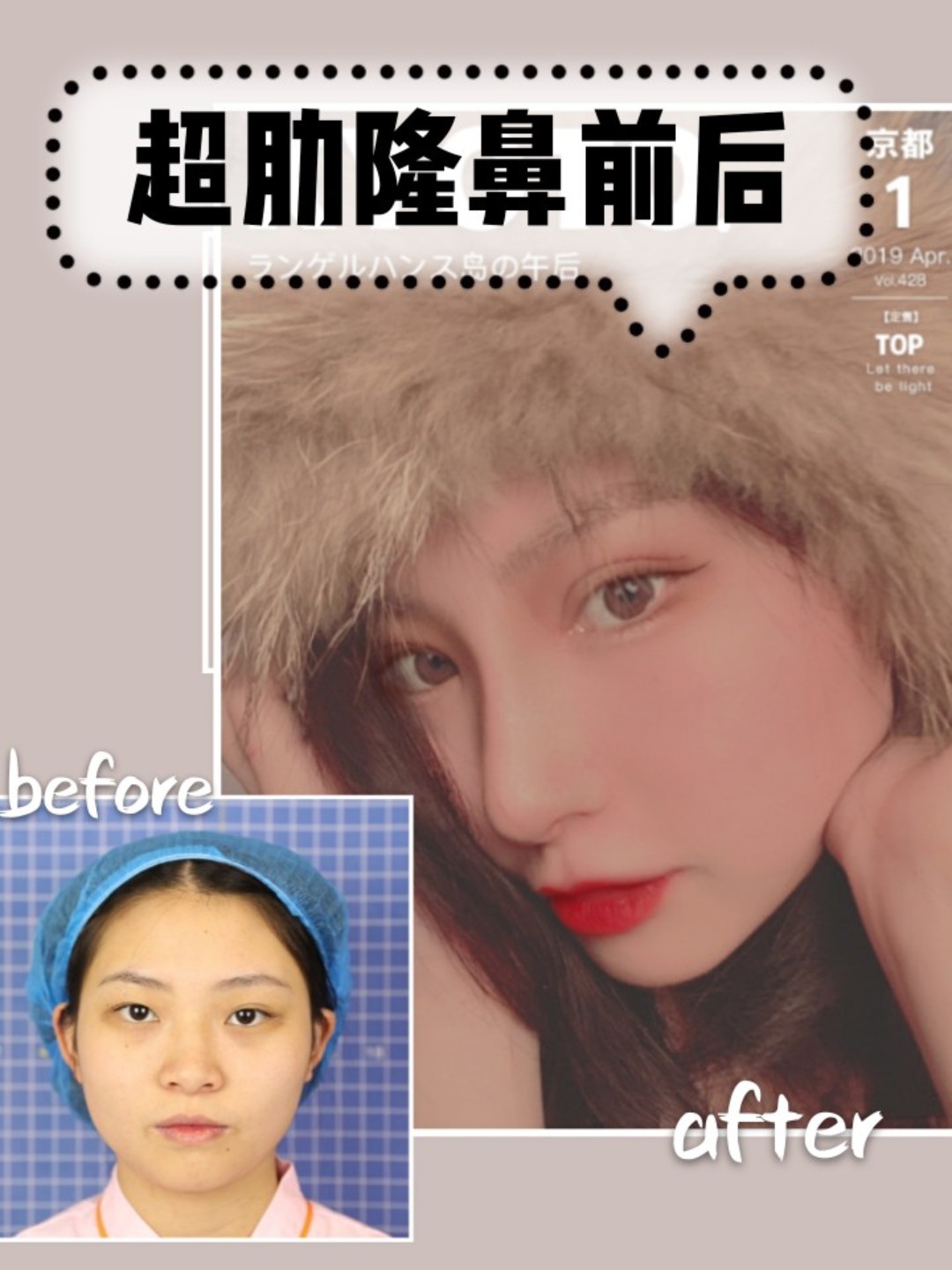 超肋隆鼻分享 说实话很后悔 后悔为什么不早在做 圈子 新氧美容整形