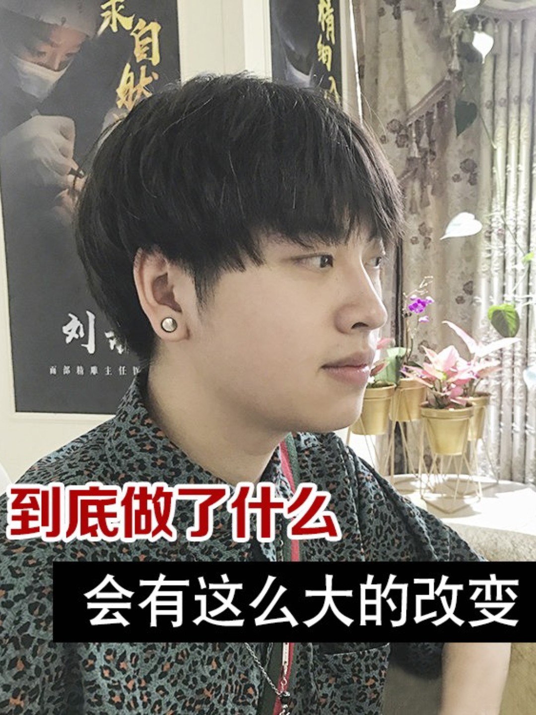 【修脸形案例分享】小帅哥颏肌紧张,下巴后缩导致嘴凸_圈子-新氧美容