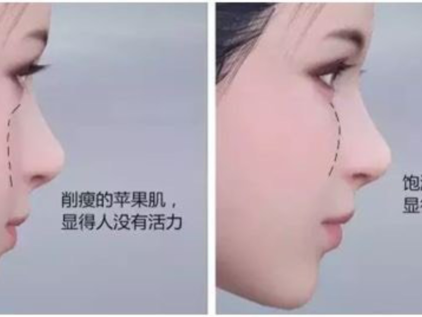 苹果肌扁平下垂大多是两种原因造成