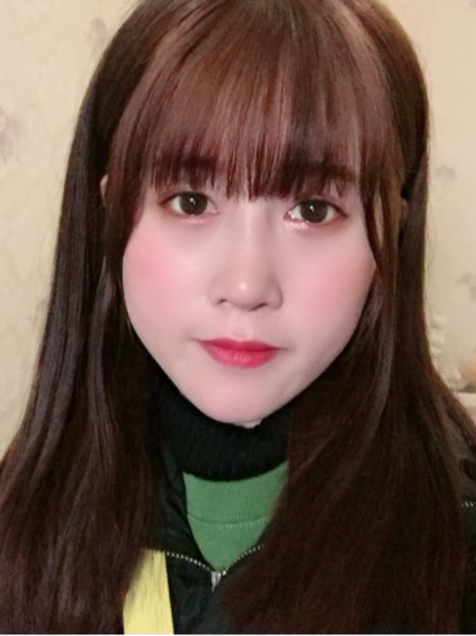 9696超真实隆鼻术后经验分享969678术后脸部的消肿过程