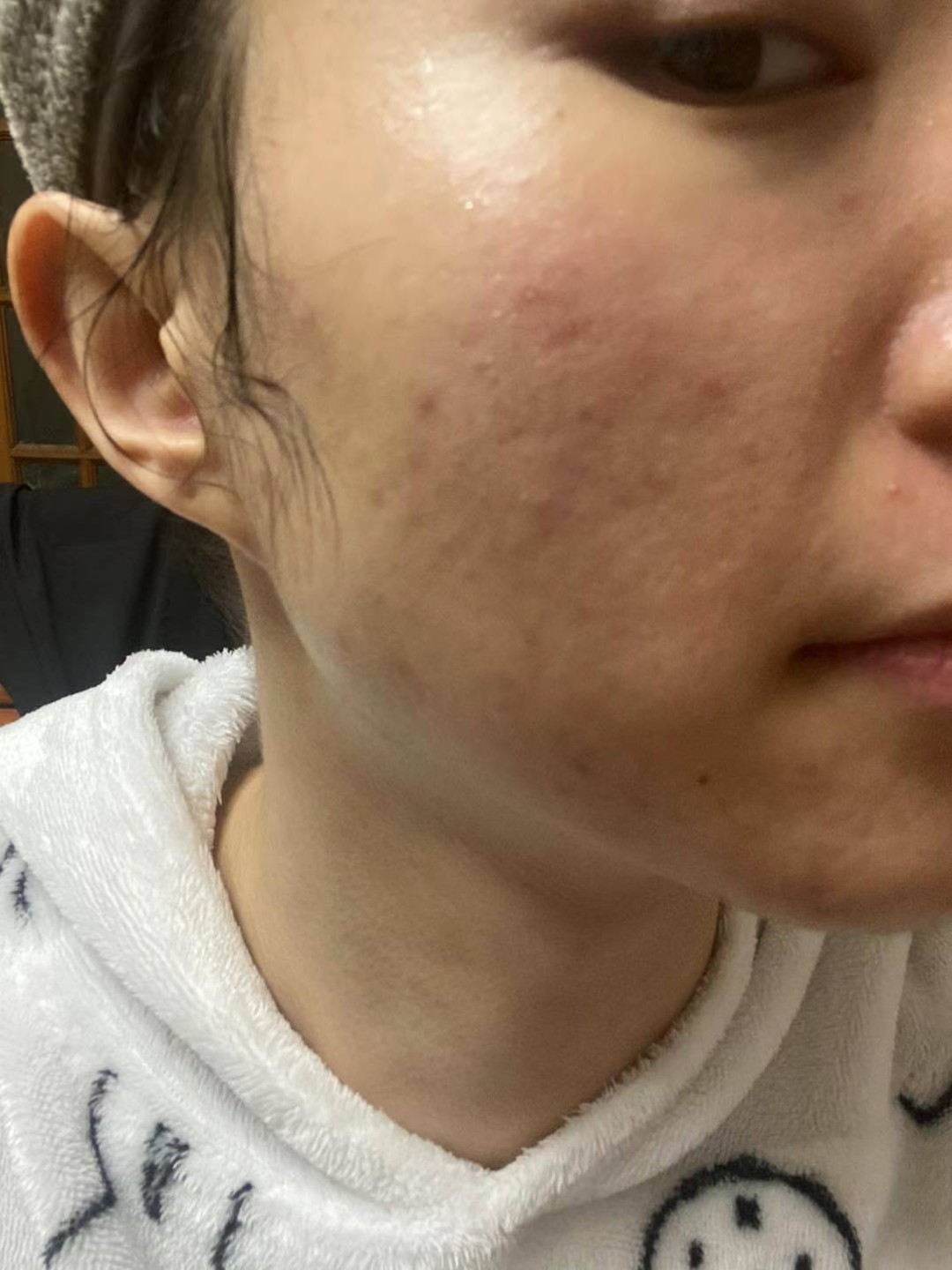 前两天去清了一次痘了,感觉激光清痘简直就是黑科技,_圈子-新氧美容