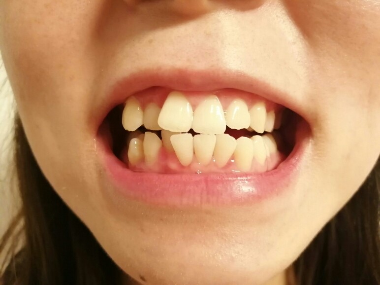 牙齿凹凸不平图片