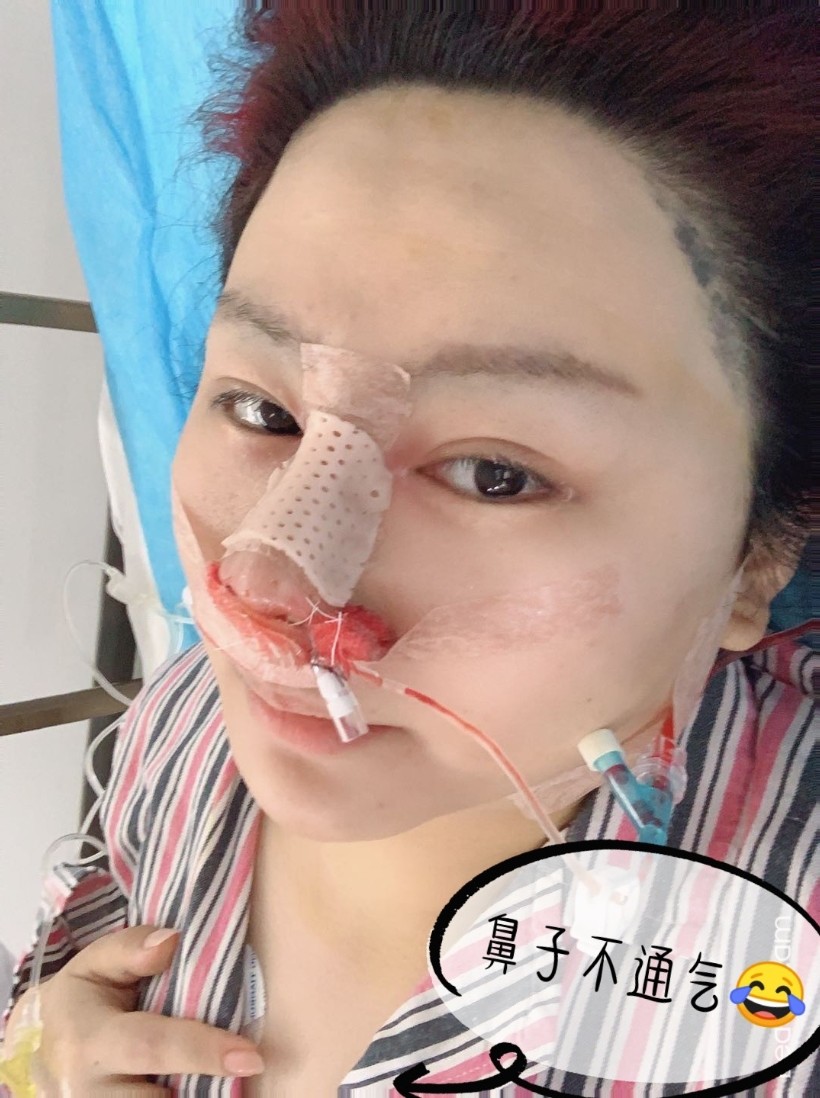 【术后第二天】医生给我塞了膨胀海绵,本来就肿,鼻子_圈子-新氧美容