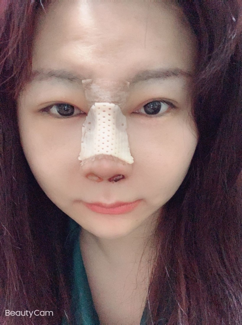 【术后第二天】医生给我塞了膨胀海绵,本来就肿,鼻子_圈子-新氧美容