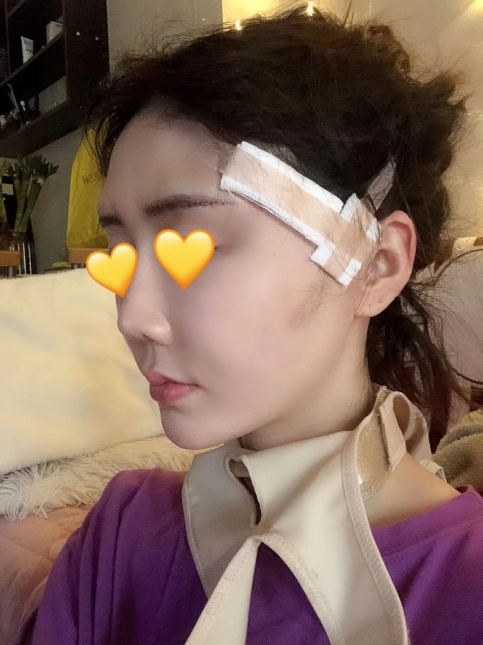 立秀膨体垫眉弓 微拉美 术后第1天