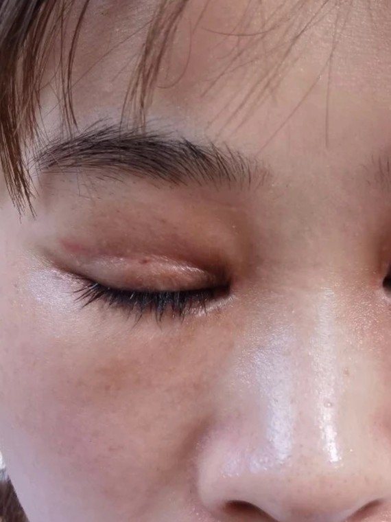 100天了闭眼痕迹明显睁眼肉条感严重皮下组织硬硬的_圈子-新氧美容