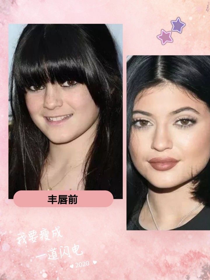 薄唇女孩的4种丰唇术