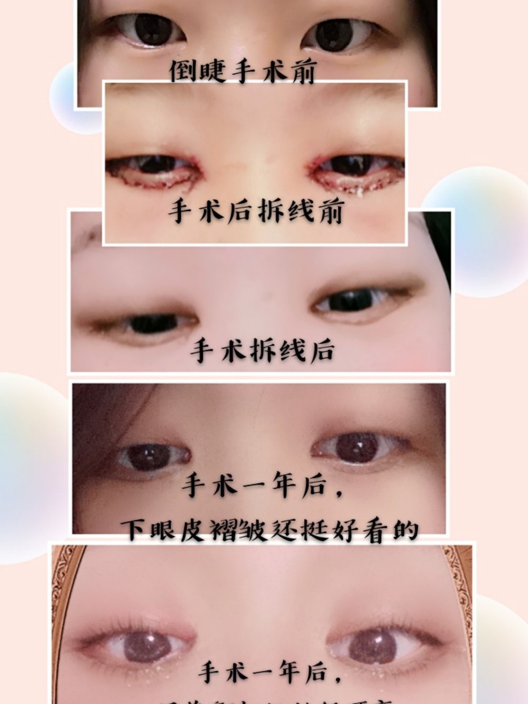 分享自己做倒睫手术的恢复过程,以及前后对比照,虽然只是倒睫,但是