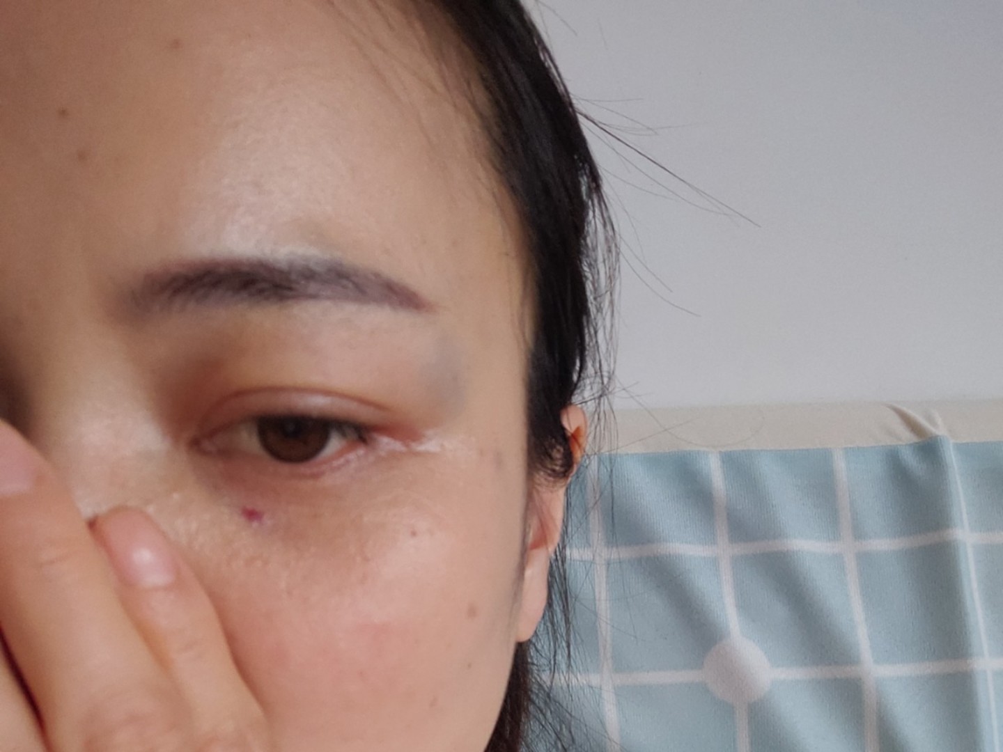 这是刚刚打完的1个半小时0000右眼角明显淤青,又泪沟_圈子-新氧