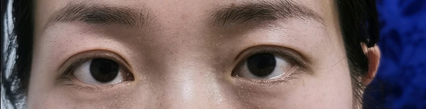 我右眼眼头那可以恢复成和左眼一样吗