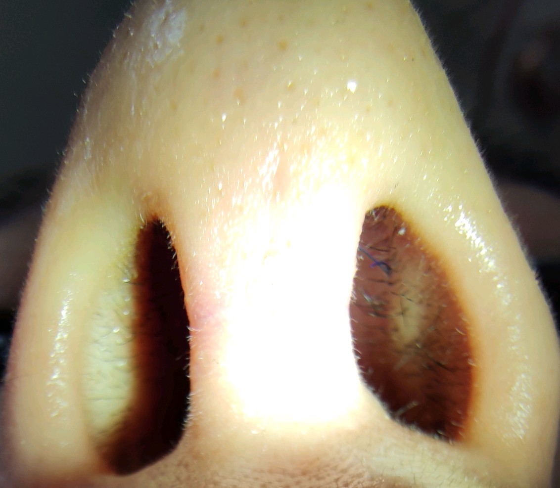 鼻腔内部真实图片图片