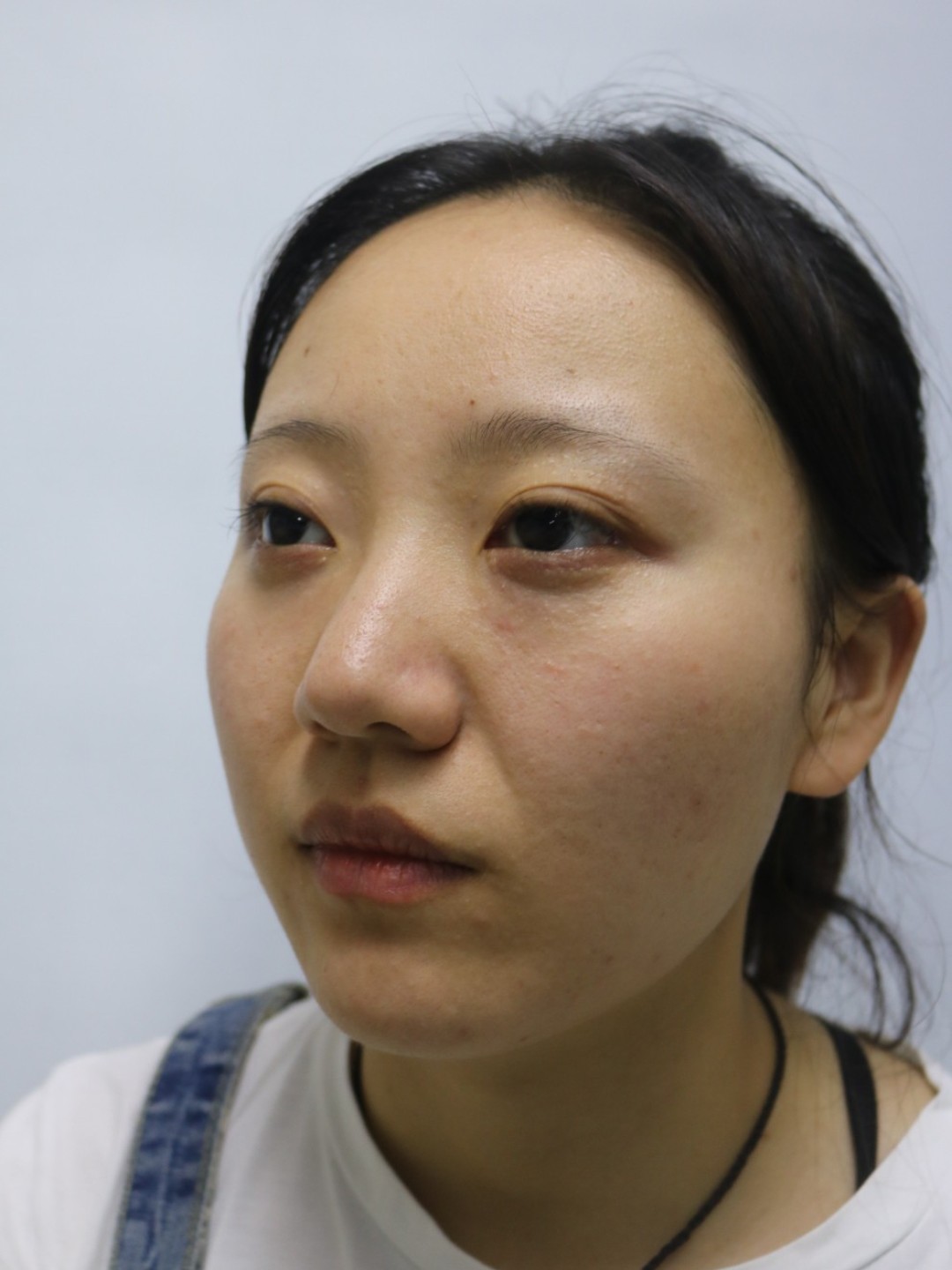 【陈叔的 修脸形 案例分享】太阳穴凹陷,苹果肌下垂_圈子-新氧美容