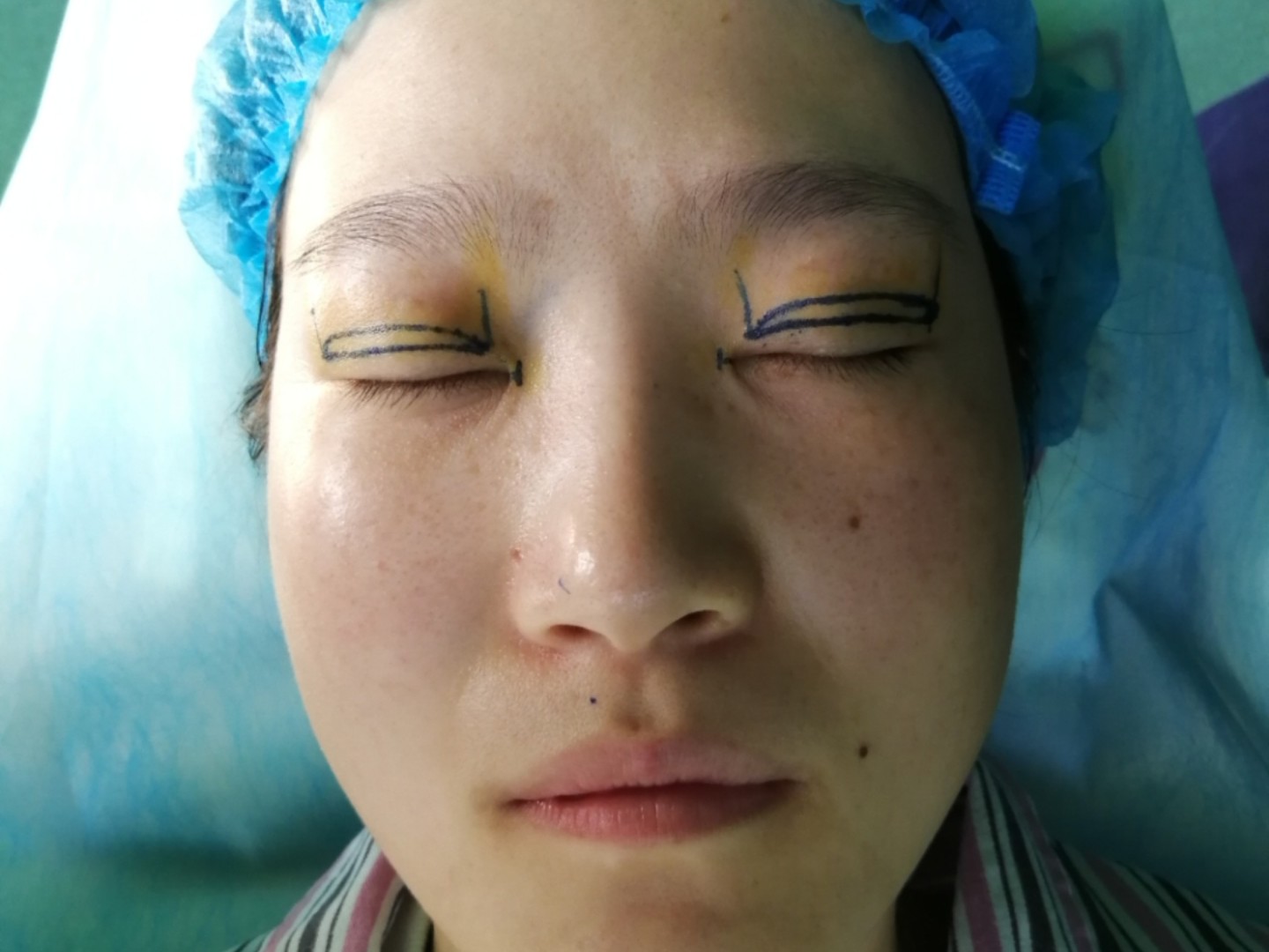 我的眼睛有点提肌无力,眼球暴露也不是很明显,看着有_圈子-新氧美容