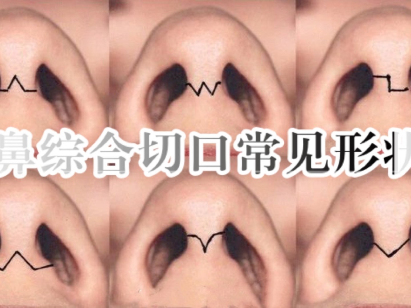 鼻部多项手术开放式切口的常见形状