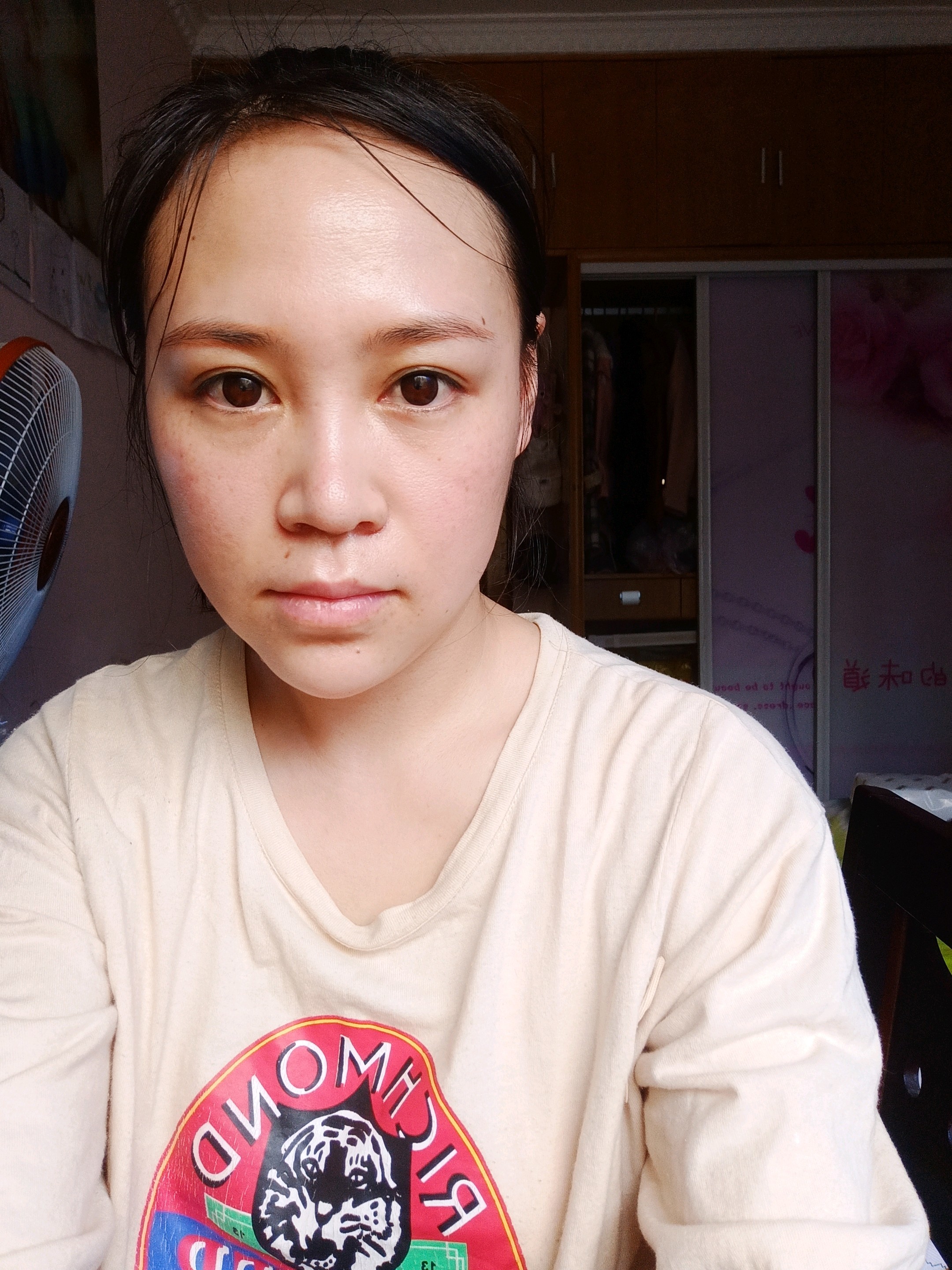 我的缩鼻翼手术是不是失败了十一天了为什么看起来还是很大