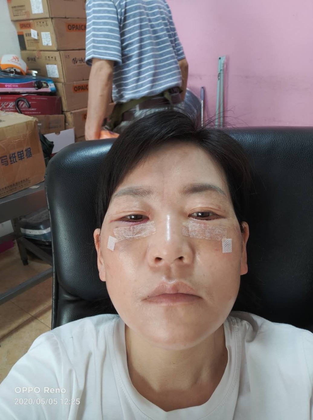 大家好,今天分享一个本人的去眼袋日记,_圈子-新氧美容整形